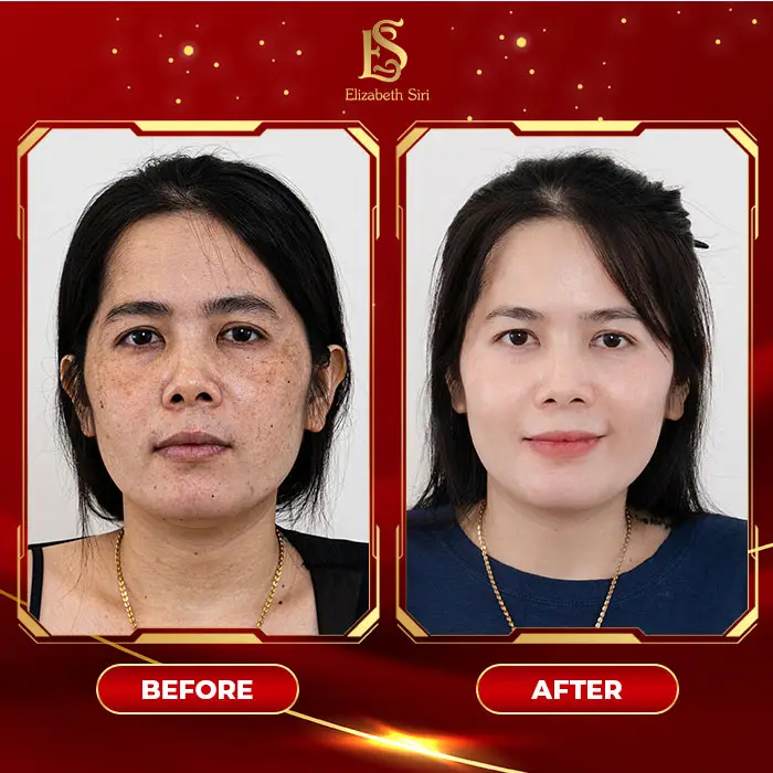 Phòng Khám Da Liễu Elizabeth Siri – Chuyên Điều Trị Nám Da