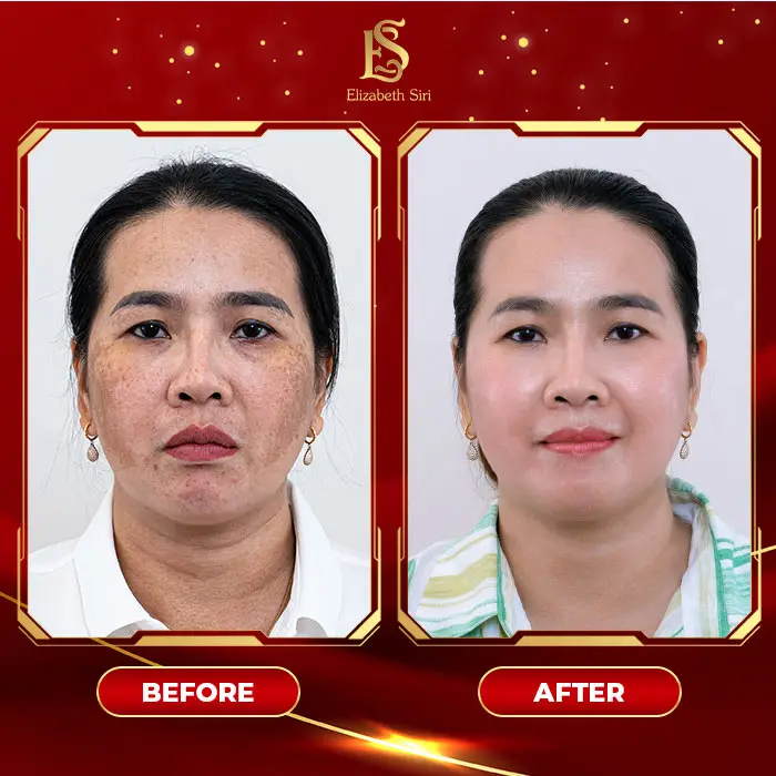 Phòng Khám Da Liễu Elizabeth Siri – Chuyên Điều Trị Nám Da