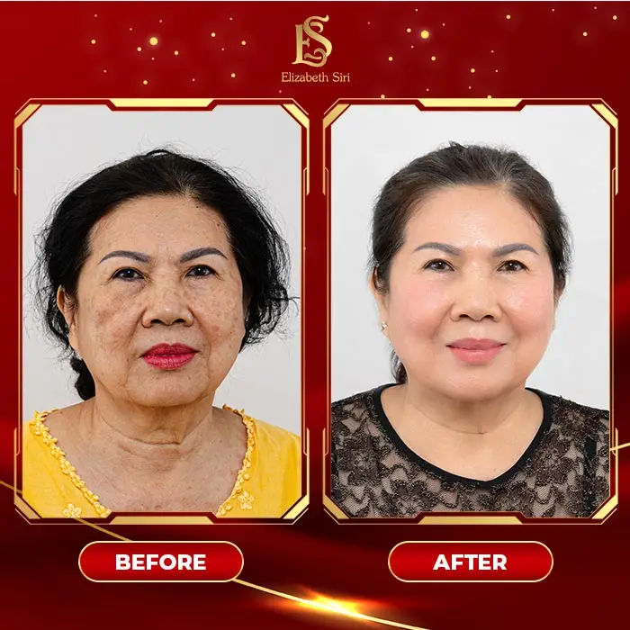 Phòng Khám Da Liễu Elizabeth Siri – Chuyên Điều Trị Nám Da