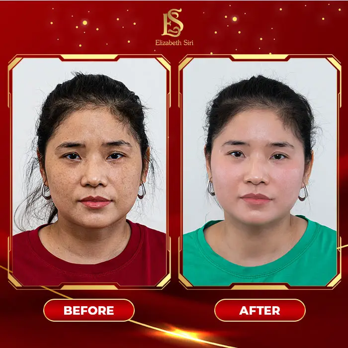 Phòng Khám Da Liễu Elizabeth Siri – Chuyên Điều Trị Nám Da