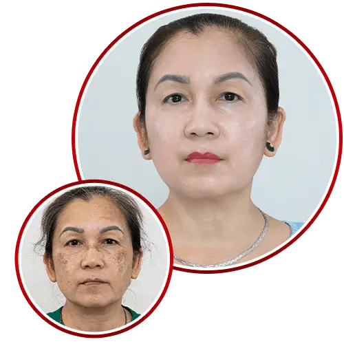 Phòng Khám Da Liễu Elizabeth Siri – Chuyên Điều Trị Nám Da